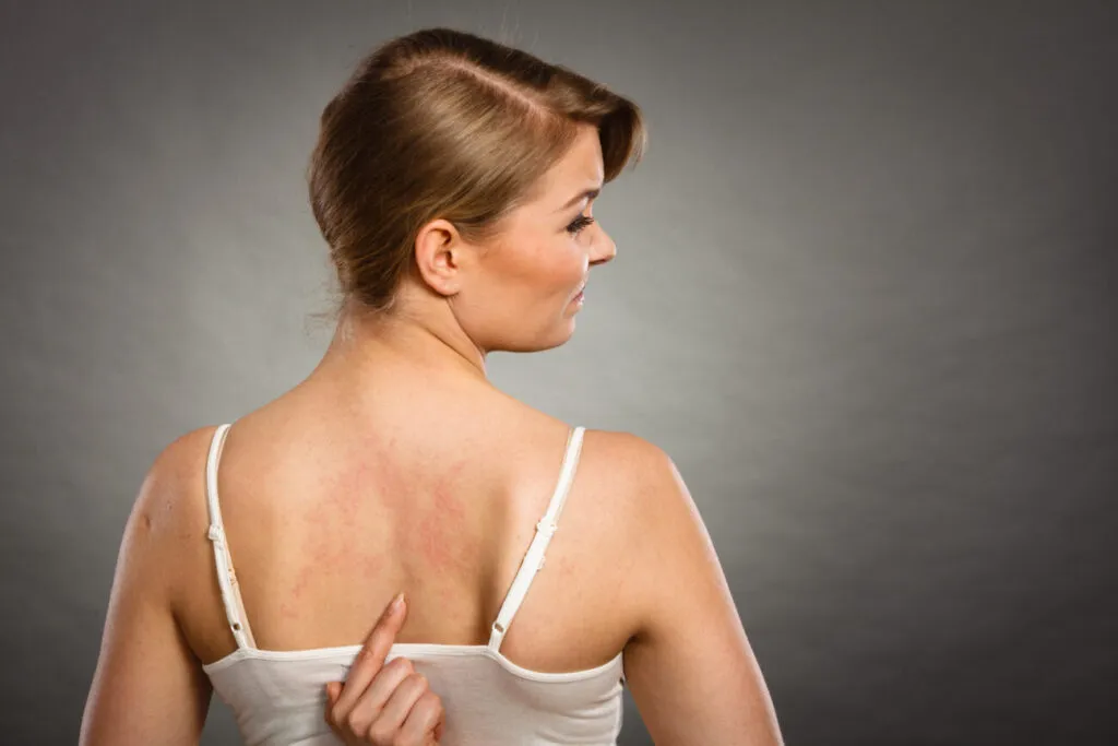La importancia de los Omega-3 en dermatitis, psoriasis y eczemas